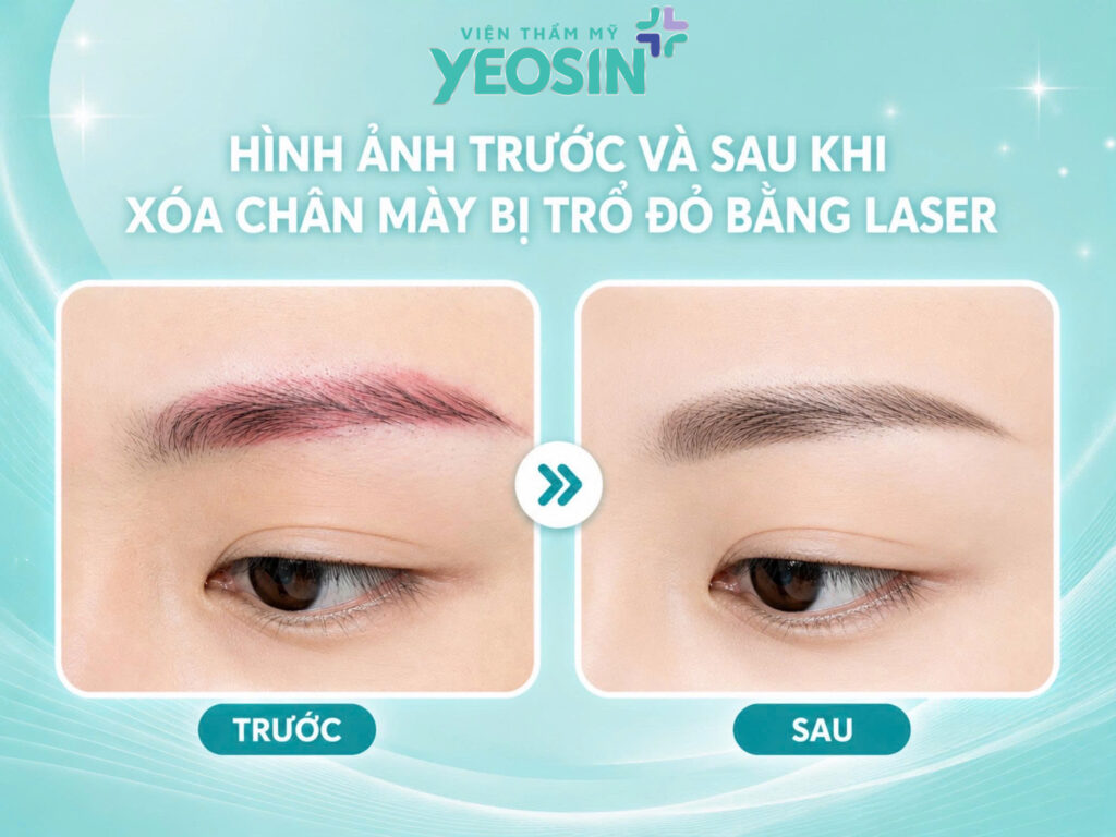 Hình ảnh trước và sau khi xóa chân mày bị trổ đỏ bằng laser tại Viện Thẩm Mỹ Yeosin.