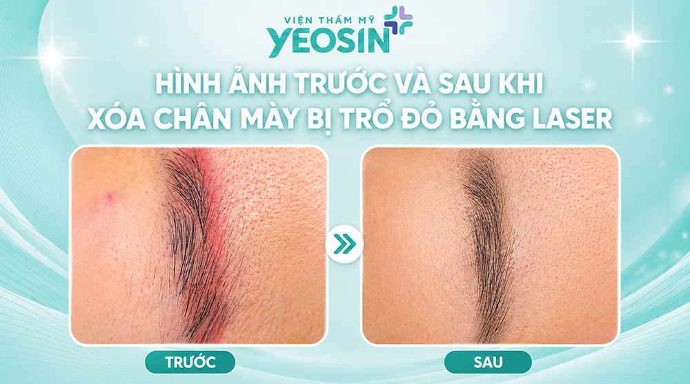 Hình ảnh trước và sau khi xóa chân mày bị trổ đỏ bằng laser tại Viện Thẩm Mỹ Yeosin.