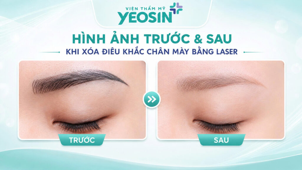 Hình ảnh trước và sau khi xóa điêu khắc chân mày bằng laser tại Viện Thẩm Mỹ Yeosin.