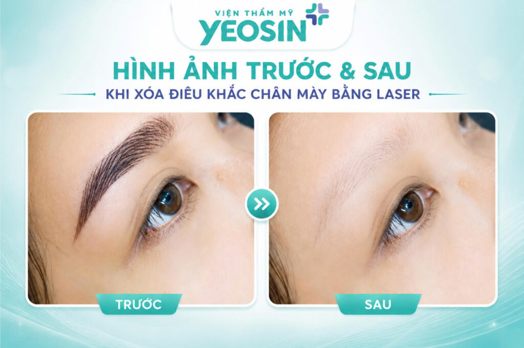 Hình ảnh trước và sau khi xóa điêu khắc chân mày bằng laser tại Viện Thẩm Mỹ Yeosin.