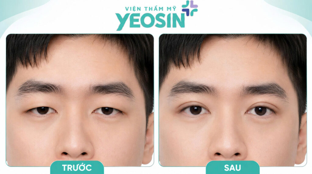 Cắt mí nam giới và những điều cần biết. 12 Hình ảnh trước và sau khi cắt mí nam giới tại Viện Thẩm Mỹ Yeosin
