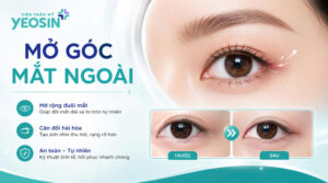Mở góc mắt ngoài - Những điều cần biết khi mở rộng góc mắt ngoài