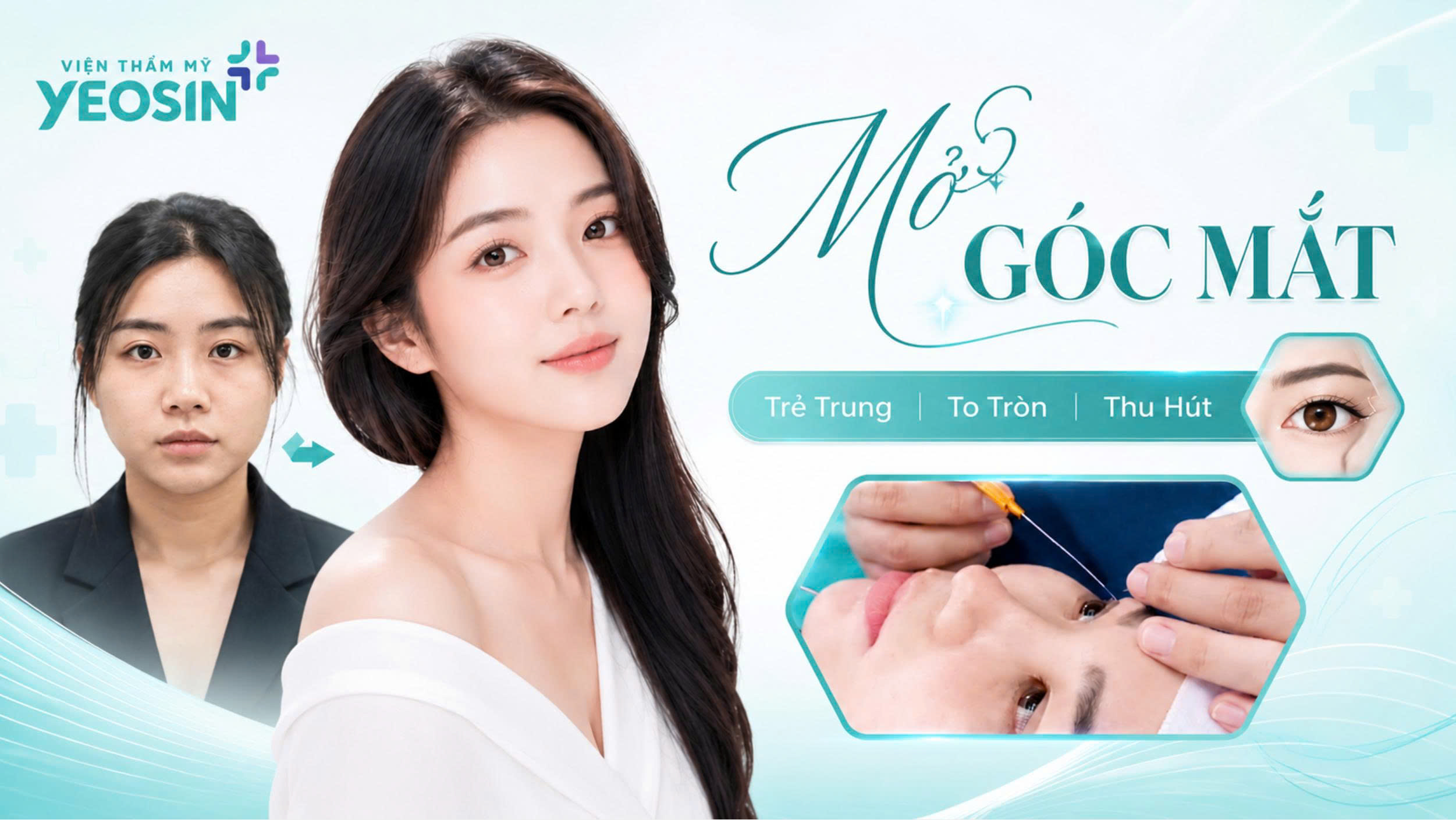 Mở góc mắt - Phẫu thuật mở rộng góc mắt