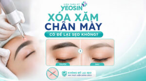 Xóa xăm chân mày có để lại sẹo không