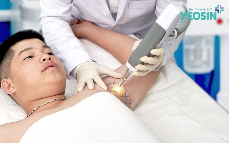 Loại bỏ tuyến mồ hôi nách: Giải pháp hỗ trợ giảm mồ hôi và hôi nách 16 Loại bỏ tuyến mồ hôi nách bằng công nghệ Fast Ultra Plus tại Yeosin
