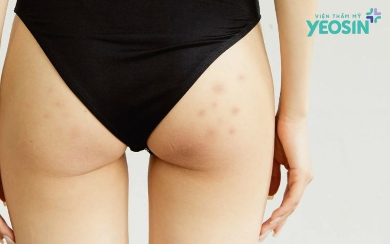 Thâm mông: Nên chăm sóc tại nhà hay điều trị chuyên sâu? 5 Thâm mông có phải lúc nào cũng cần điều trị?