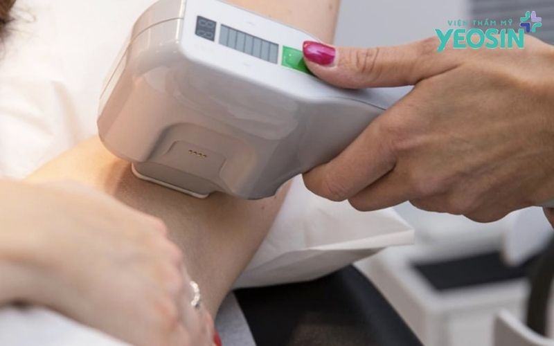 Loại bỏ tuyến mồ hôi nách: Giải pháp hỗ trợ giảm mồ hôi và hôi nách 17 Ưu điểm của công nghệ Fast Ultra Plus