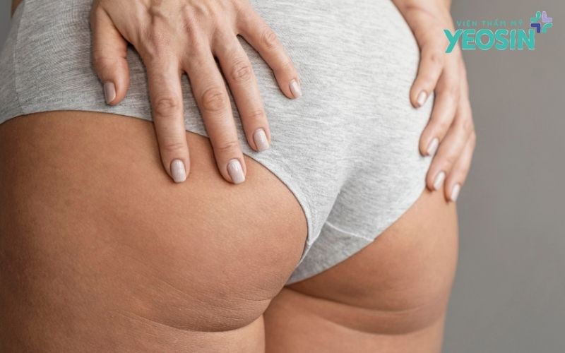 Thâm mông: Nên chăm sóc tại nhà hay điều trị chuyên sâu? 6 Vì sao chăm sóc mãi mà vùng mông vẫn chưa đều màu?