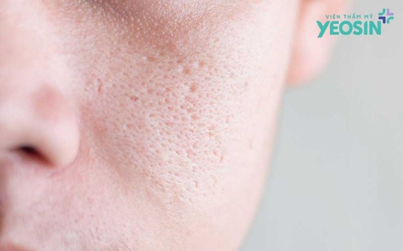 Sẹo rỗ là gì?