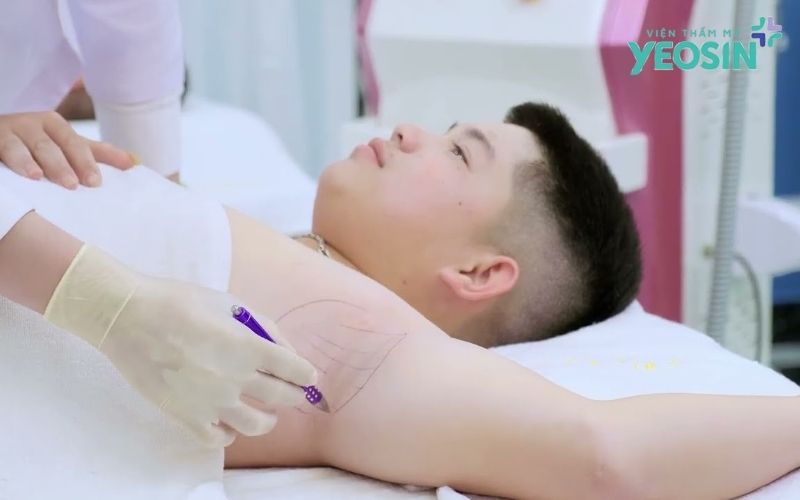 Loại bỏ tuyến mồ hôi nách: Giải pháp hỗ trợ giảm mồ hôi và hôi nách 18 Quy Trình Loại Bỏ Tuyến Mồ Hôi Nách Tại Yeosin