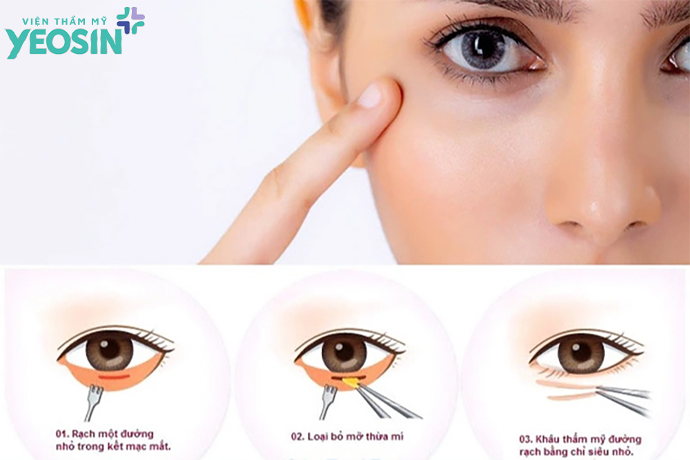 Cắt bọng mắt dưới - Có nên cắt mỡ bọng mắt dưới không? 8 Cắt bọng mắt dưới là gì?