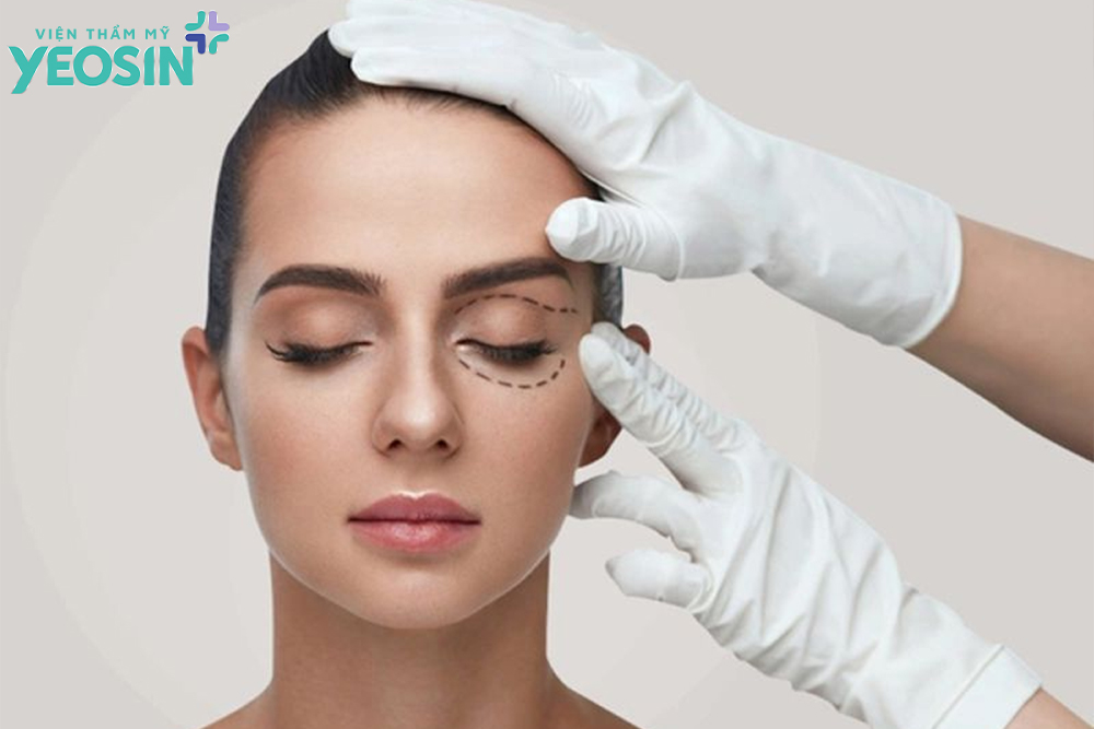 Cắt bọng mắt dưới - Có nên cắt mỡ bọng mắt dưới không? 10 Những lưu ý khi cắt bọng mắt dưới