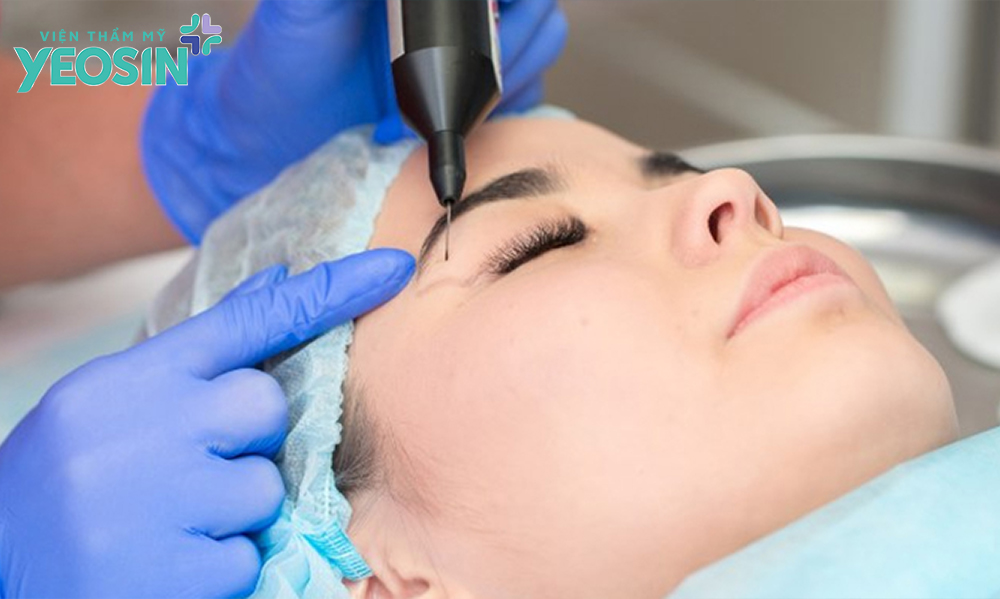 Cắt mí có đau không? Cách chăm sóc da sau khi cắt mí mắt 12 Vậy trong quá trình thực hiện cắt mí có đau không?