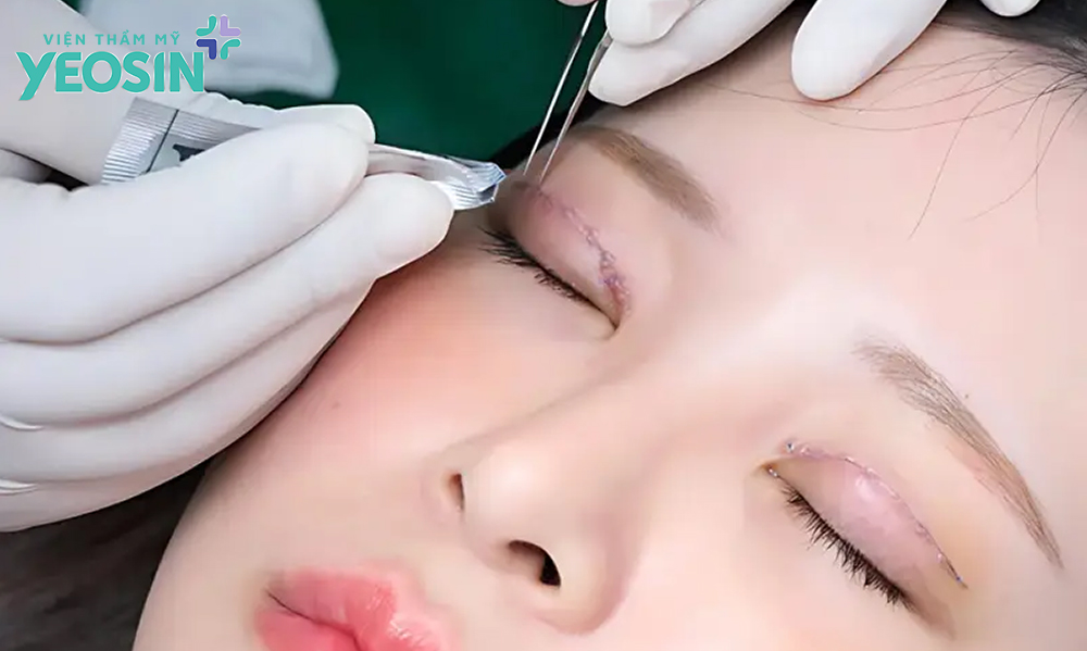 Cắt mí có đau không? Cách chăm sóc da sau khi cắt mí mắt 13 Các yếu tố ảnh hưởng đến vấn đề cắt mí có đau không.