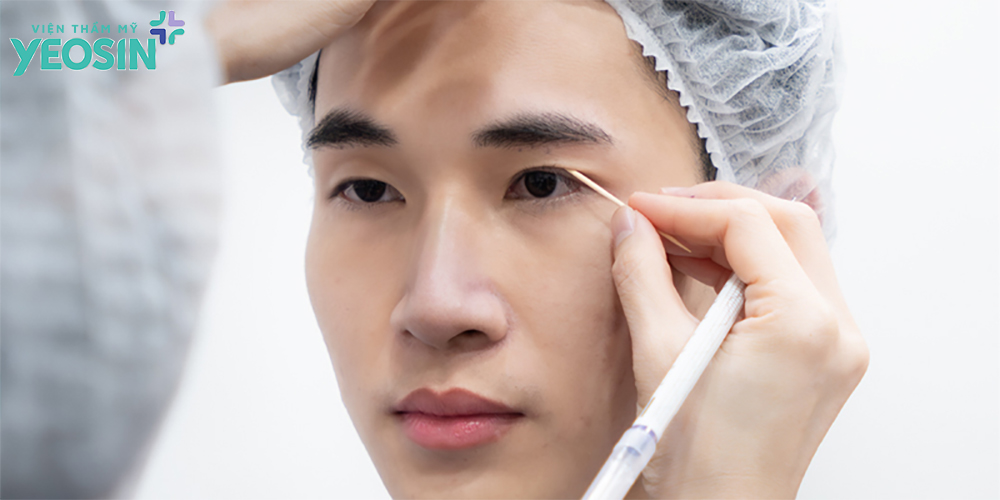 Cắt mí nam giới và những điều cần biết. 7 Cắt mí nam giới là gì?