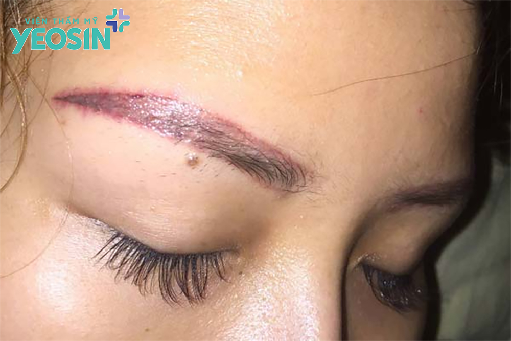 Lông mày bị trổ đỏ: Nguyên nhân và cách xóa chân mày trổ đỏ 6 Lông mày bị trổ đỏ là gì?