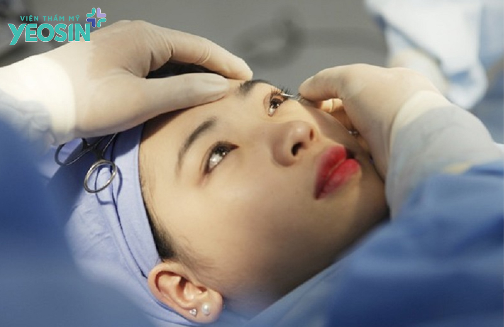 Mở góc mắt ngoài có đau không?