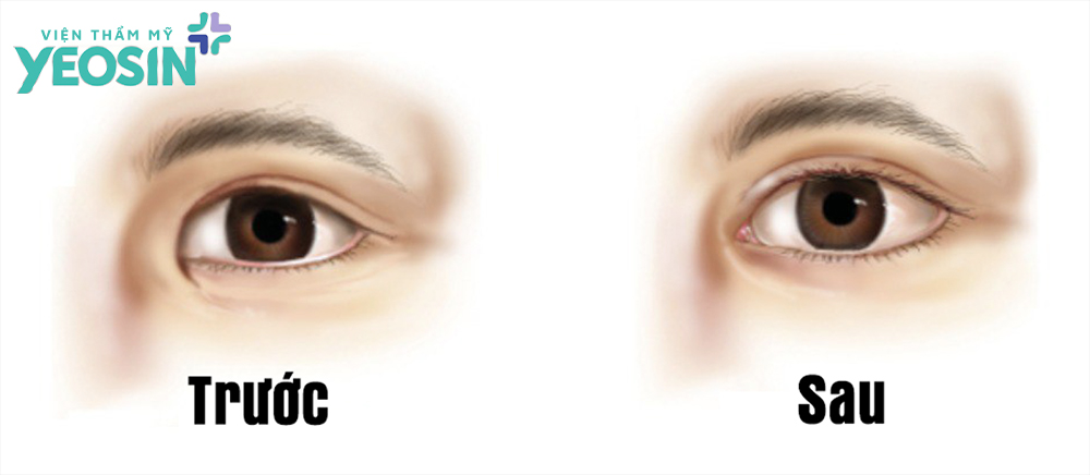 Mở rộng góc mắt trong là gì?