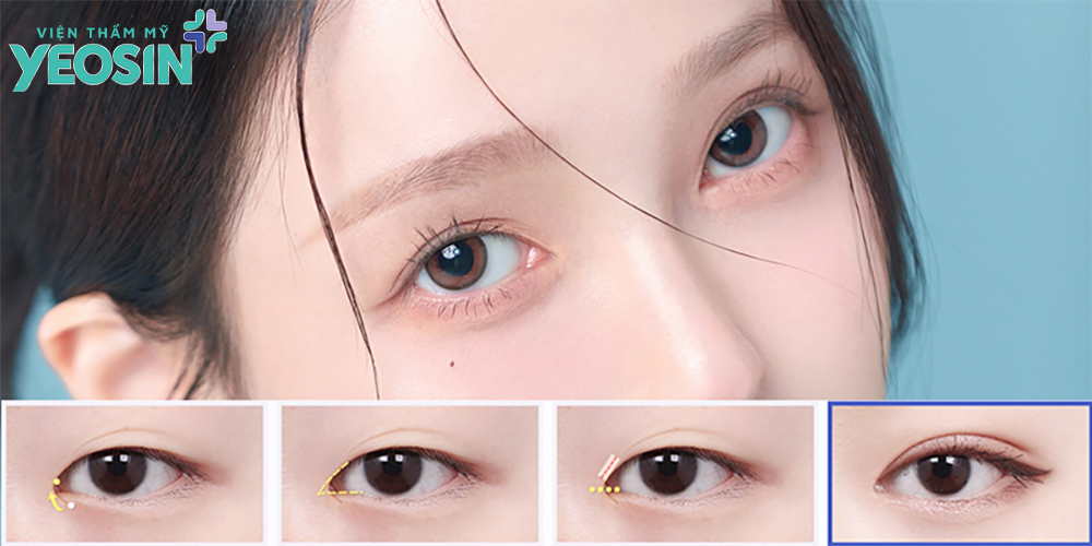 Ưu điểm nhận được khi mở góc mắt trong là gì?