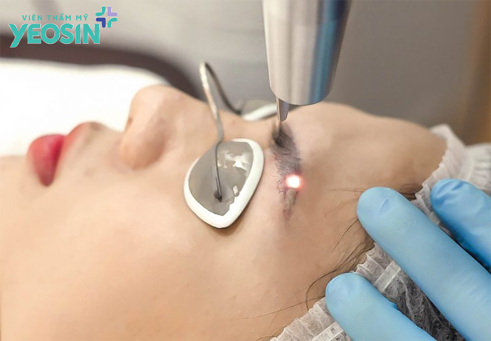 Xóa chân mày bằng laser có hết không? 10 Xóa chân mày bằng laser là gì?