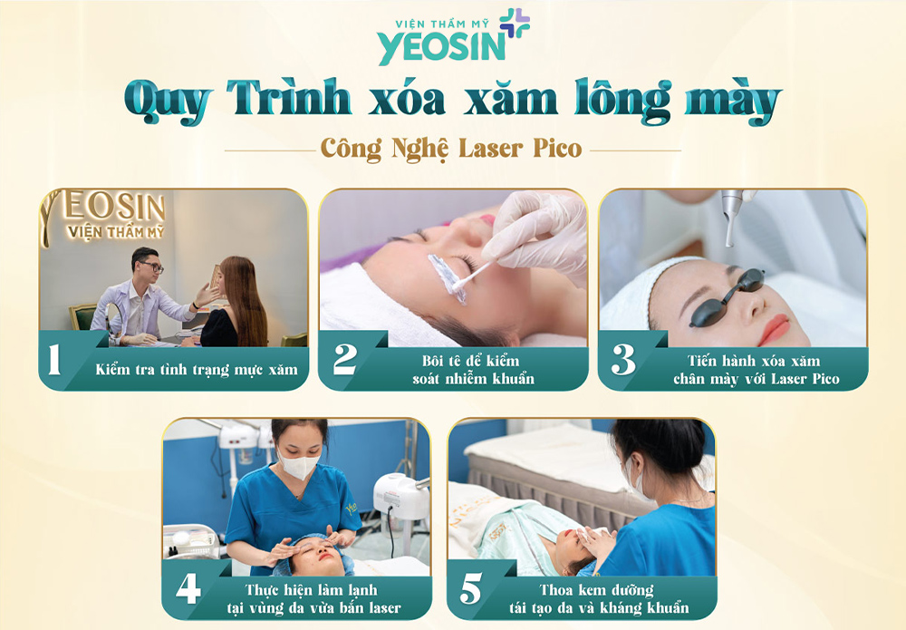 Xóa chân mày bằng laser có hết không? 12 Quy trình tẩy chân mày bằng laser chuẩn y khoa