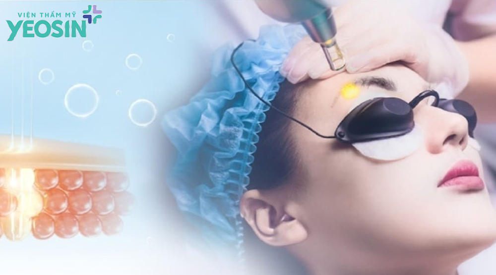 Xóa chân mày bằng laser có hết không? 11 Xóa chân mày bằng laser có để sẹo không?
