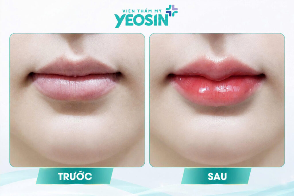 Hình ảnh trước và sau khi tiêm môi trái tim tại Yeosin