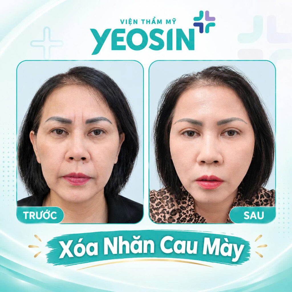 Chi phí xóa nếp nhăn ấn đường giá bao nhiêu? 16 Hình ảnh trước và sau khi xóa nếp nhăn cau mày tại Yeosin