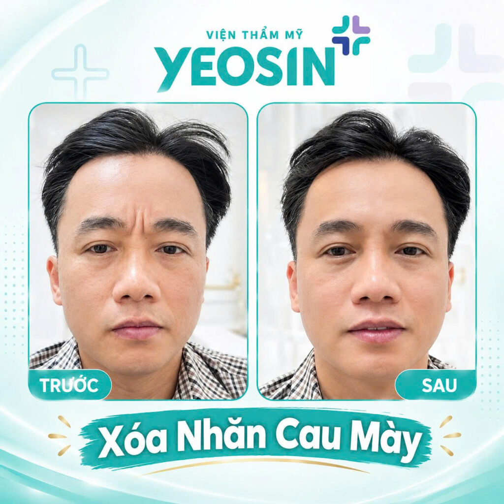 Chi phí xóa nếp nhăn ấn đường giá bao nhiêu? 18 Hình ảnh trước và sau khi xóa nếp nhăn cau mày tại Yeosin