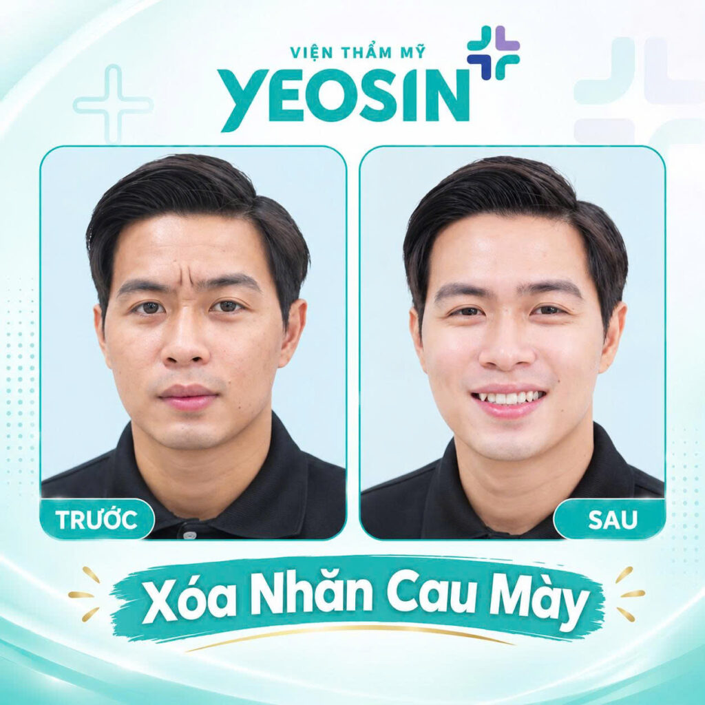 Chi phí xóa nếp nhăn ấn đường giá bao nhiêu? 17 Hình ảnh trước và sau khi xóa nếp nhăn cau mày tại Yeosin