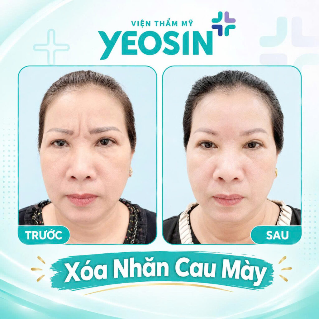 Chi phí xóa nếp nhăn ấn đường giá bao nhiêu? 19 Hình ảnh trước và sau khi xóa nếp nhăn cau mày tại Yeosin
