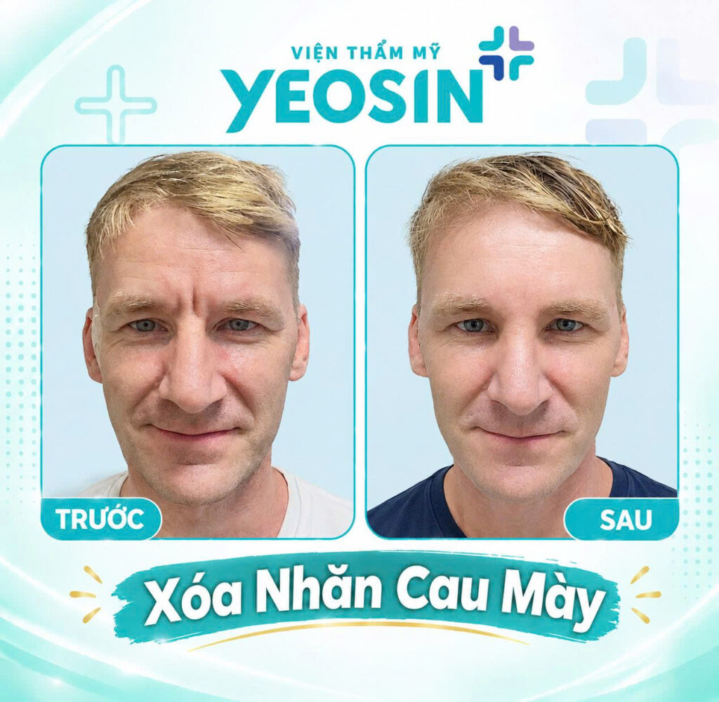 Chi phí xóa nếp nhăn ấn đường giá bao nhiêu? 20 Hình ảnh trước và sau khi xóa nếp nhăn cau mày tại Yeosin