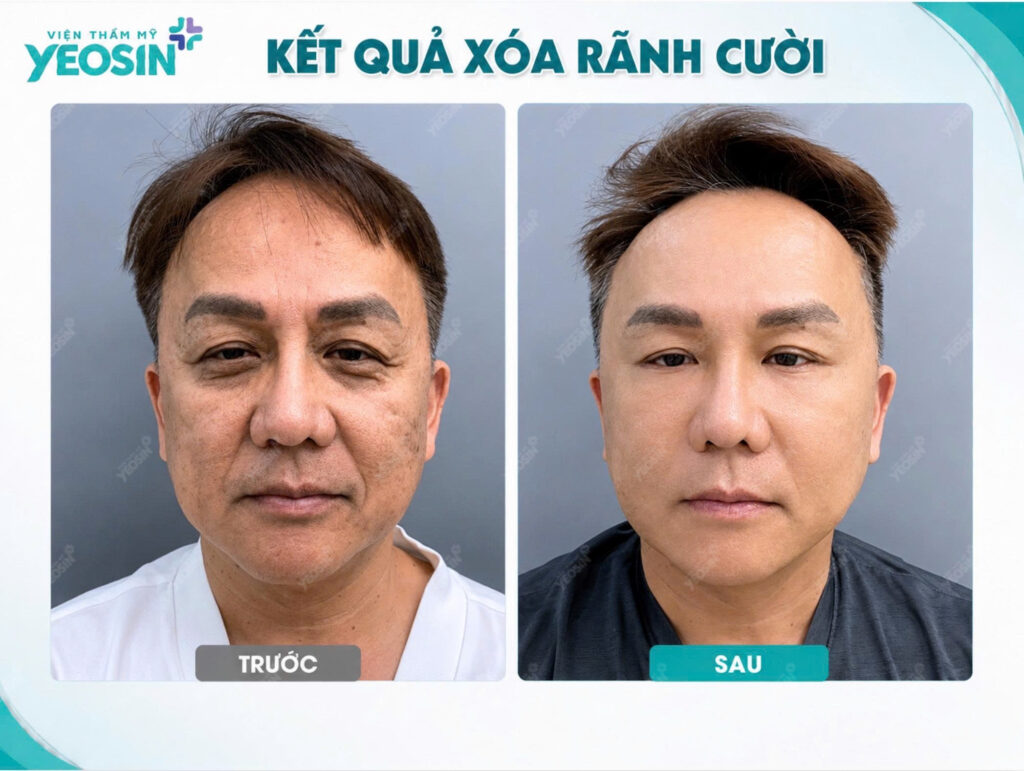 Hình ảnh trước và sau khi xóa rãnh cười tại Viện Thẩm Mỹ Yeosin