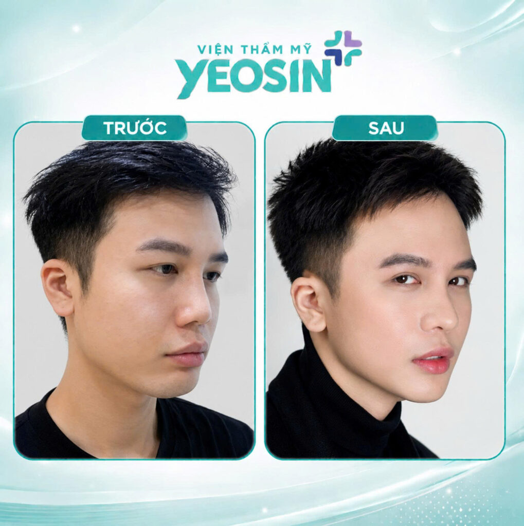 Hình ảnh trước và sau khi tiêm cằm tại Yeosin