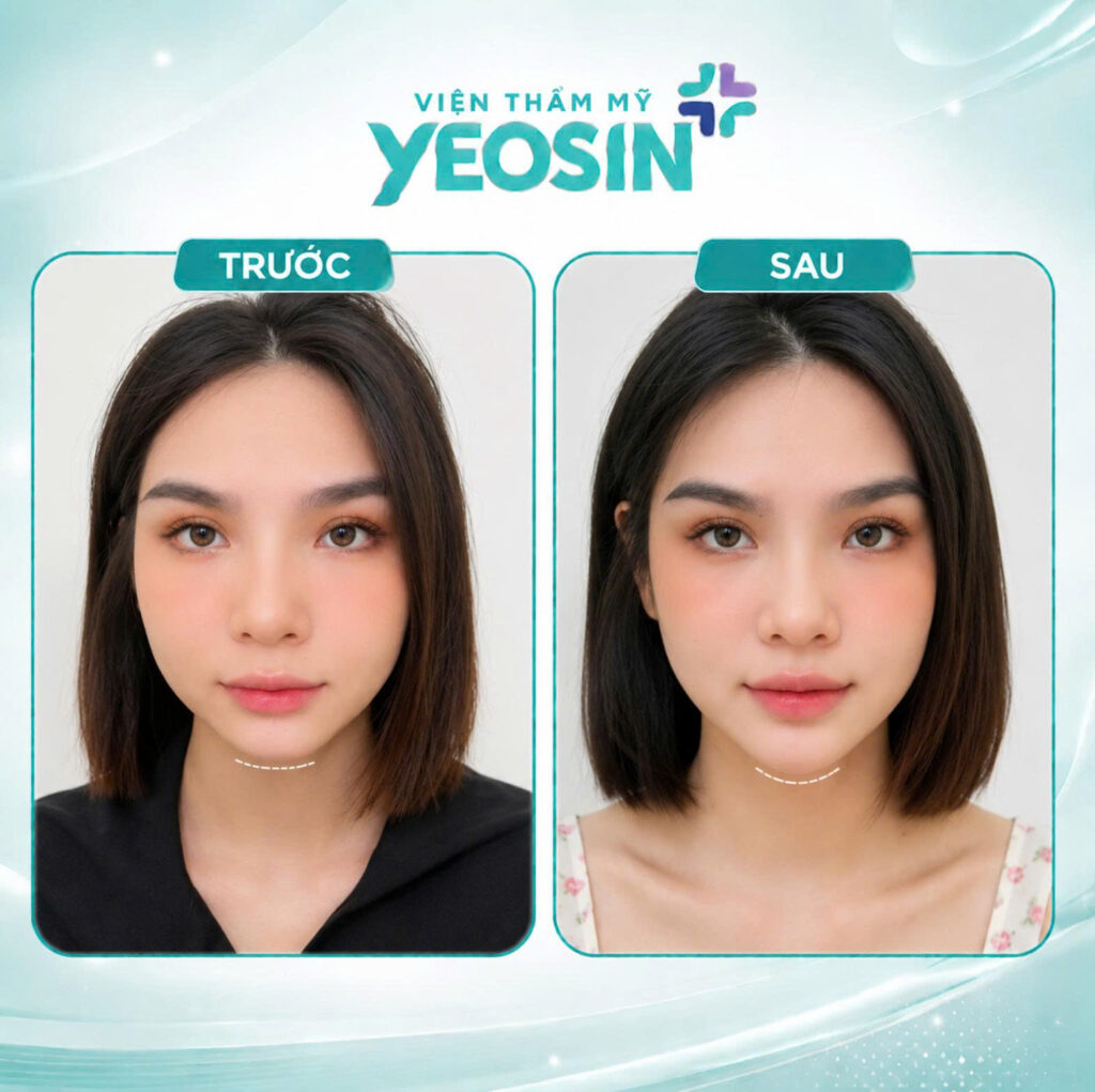 Hình ảnh trước và sau khi tiêm cằm tại Yeosin