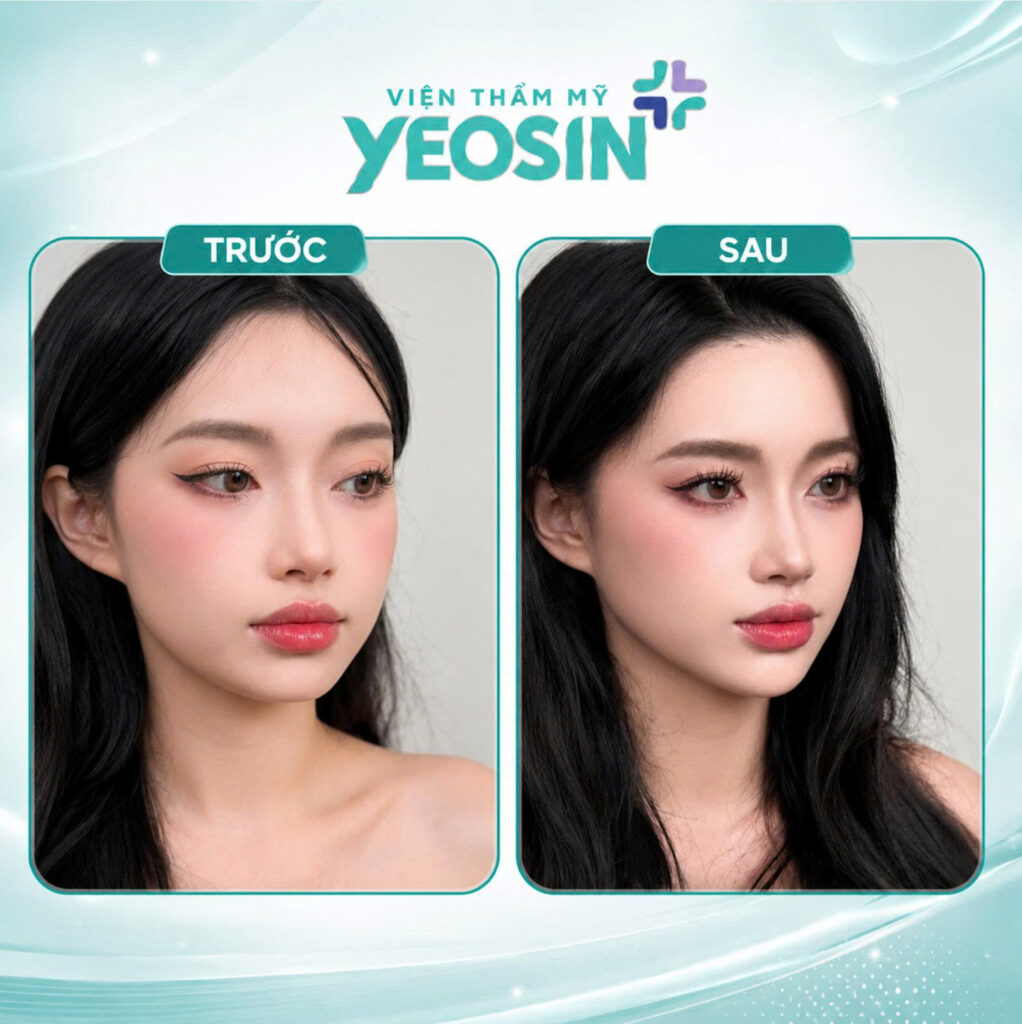Hình ảnh trước và sau khi tiêm cằm tại Yeosin