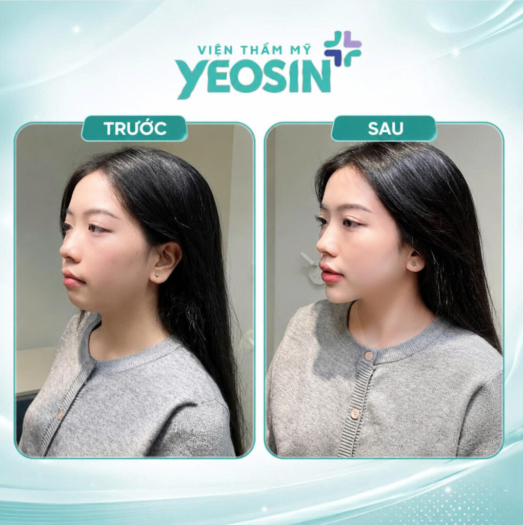 Hình ảnh trước và sau khi tiêm cằm tại Yeosin