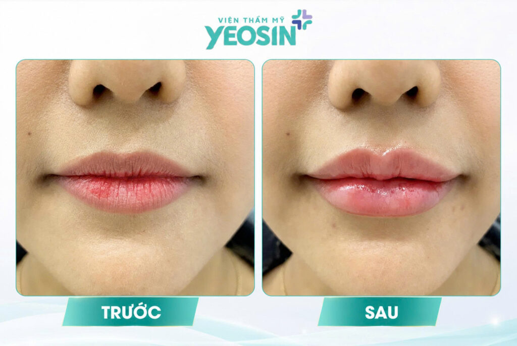 Hình ảnh trước và sau khi tiêm môi trái tim tại Yeosin