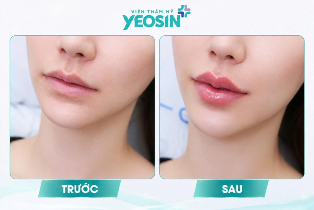Hình ảnh trước và sau khi tiêm môi trái tim tại Yeosin