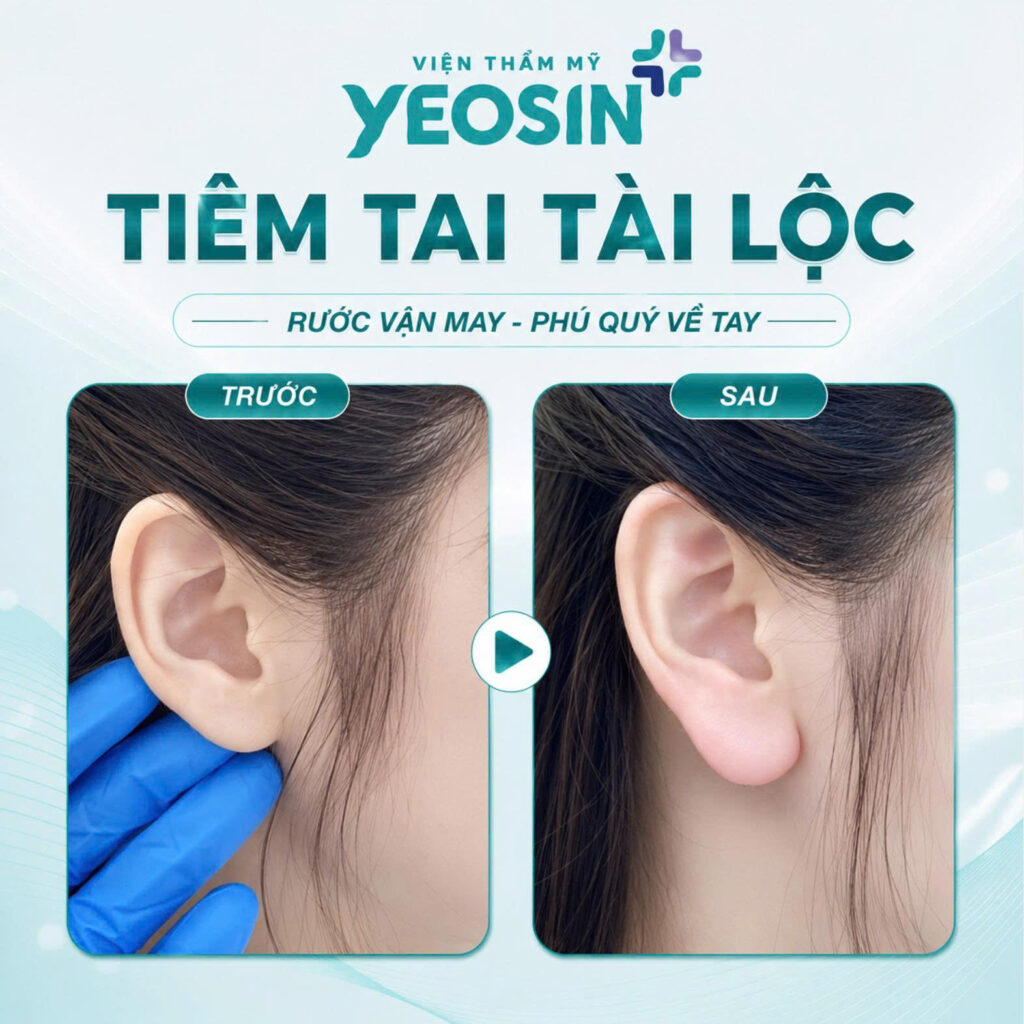 Tiêm tai tài lộc - Xu hướng làm đẹp hot năm 2026 15 Hình ảnh trước và sau khi tiêm tai tài lộc tại Yeosin