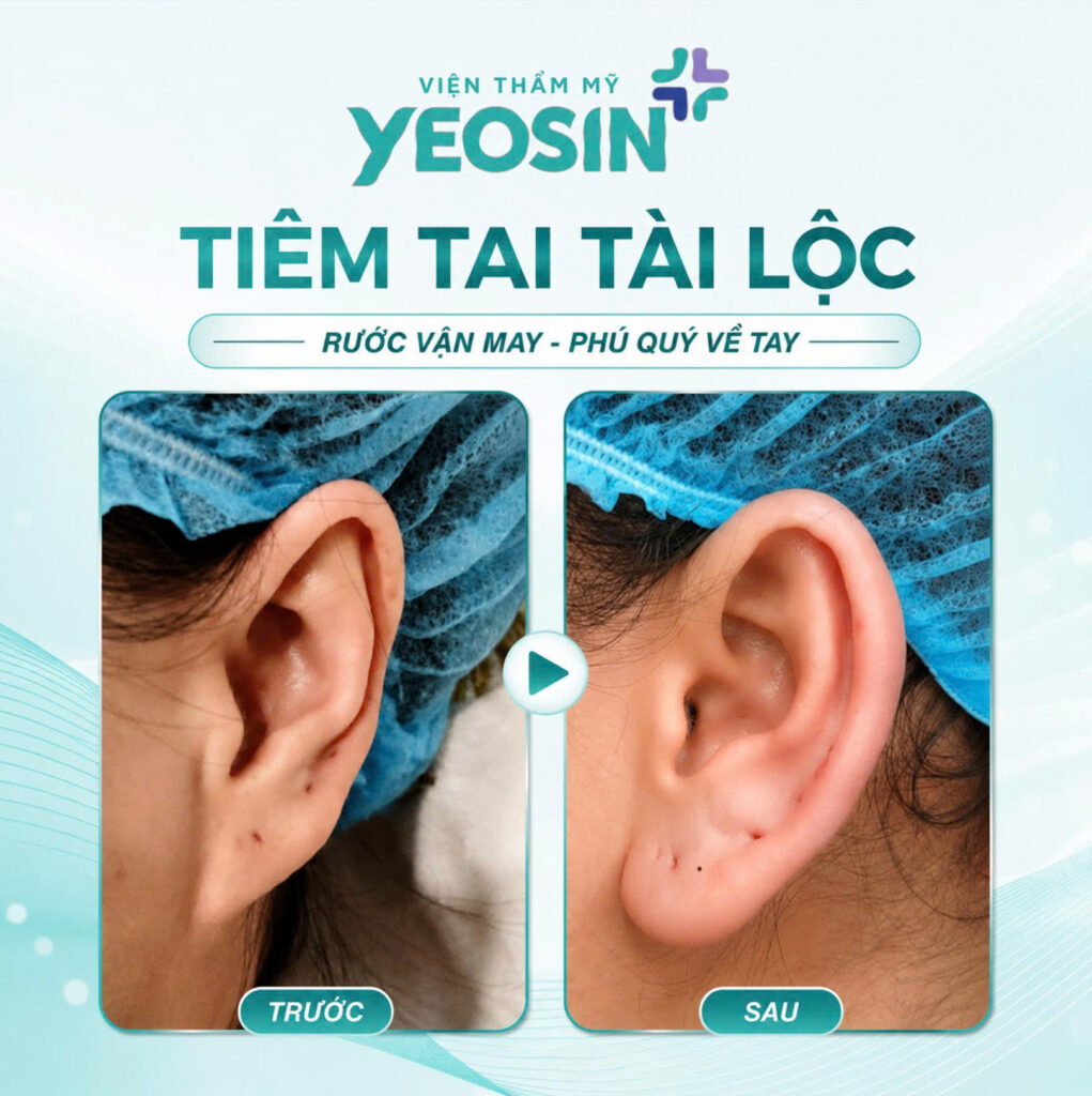 Tiêm tai tài lộc - Xu hướng làm đẹp hot năm 2026 16 Hình ảnh trước và sau khi tiêm tai tài lộc tại Yeosin