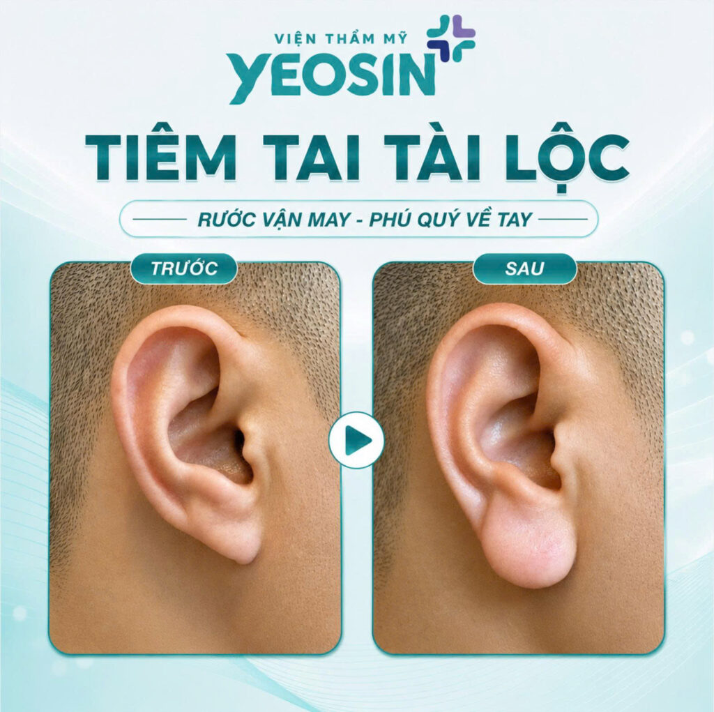 Tiêm tai tài lộc - Xu hướng làm đẹp hot năm 2026 14 Hình ảnh trước và sau khi tiêm tai tài lộc tại Yeosin