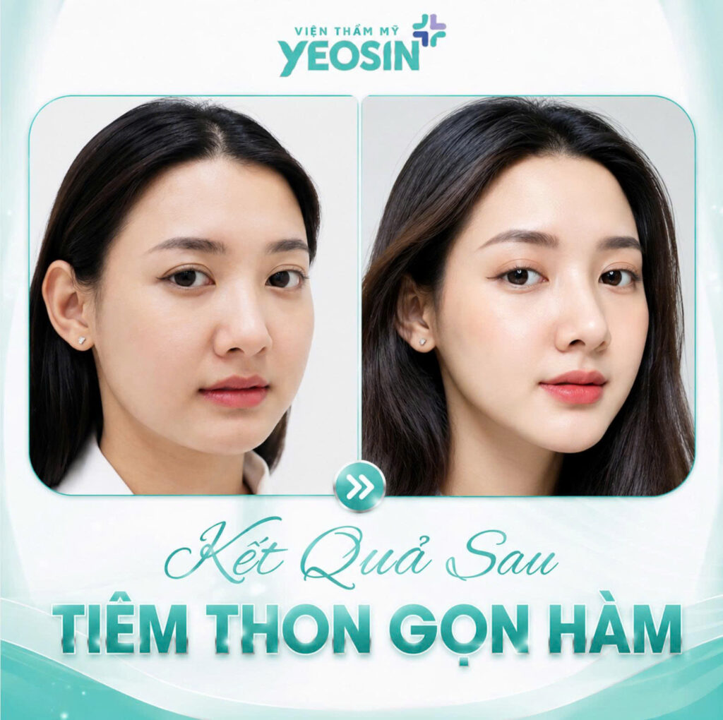 Hình ảnh trước và sau khi tiêm thon gọn hàm tại Yeosin