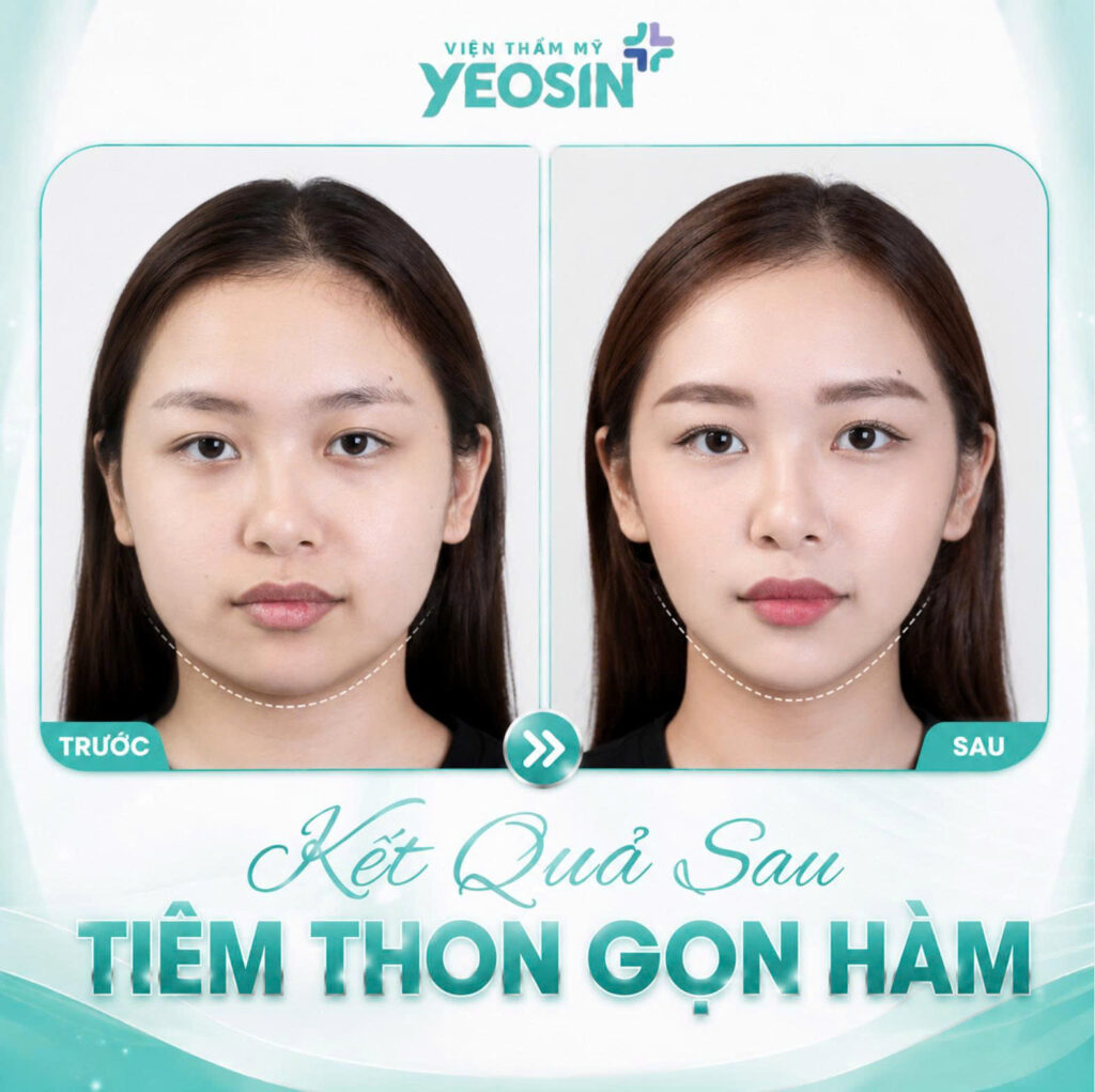 Hình ảnh trước và sau khi tiêm thon gọn hàm tại Yeosin