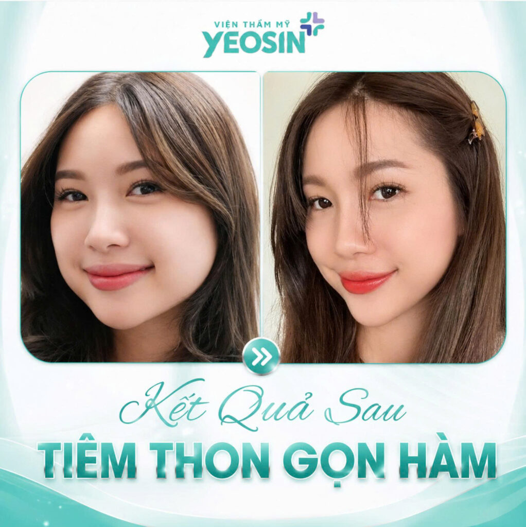 Hình ảnh trước và sau khi tiêm thon gọn hàm tại Yeosin