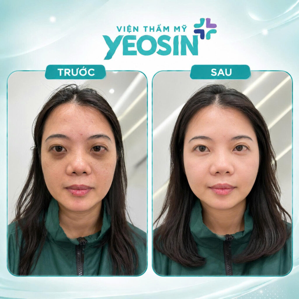 Hình ảnh trước và sau khi tiêm trị thâm quầng mắt tại Yeosin