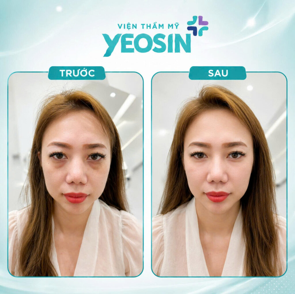 Hình ảnh trước và sau khi tiêm trị thâm quầng mắt tại Yeosin