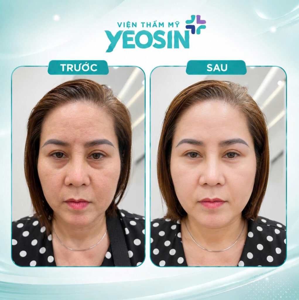 Hình ảnh trước và sau khi tiêm trị thâm quầng mắt tại Yeosin