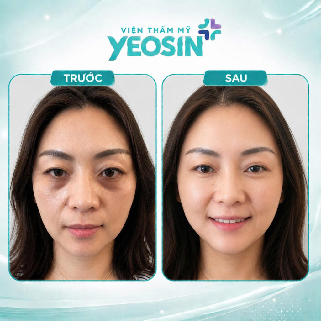 Hình ảnh trước và sau khi tiêm trị thâm quầng mắt tại Yeosin