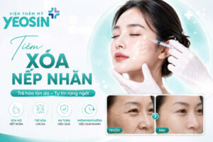 Tiêm xóa nếp nhăn - Phương pháp xóa nhăn hiệu quả